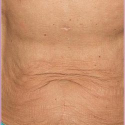 Thermage Before & After Patient #1589